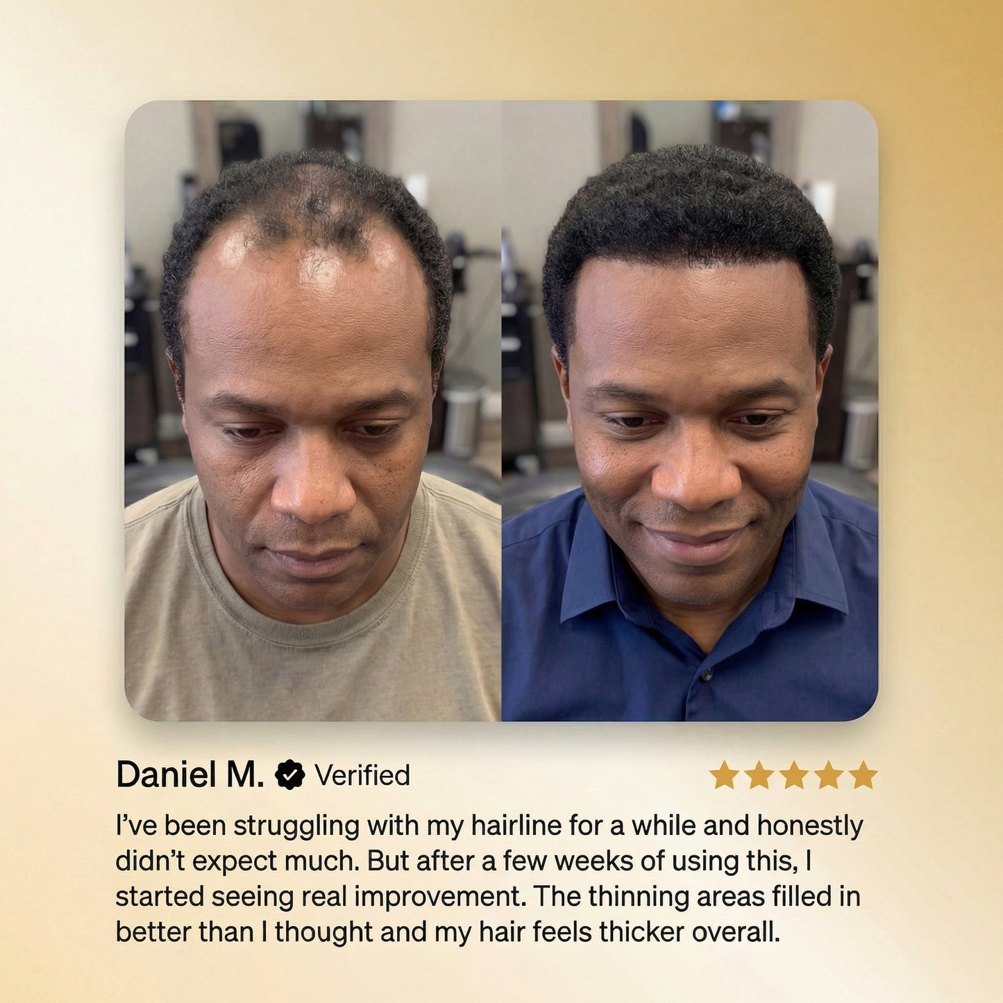 🔥LAST DAY 50% OFF!! ROSERUNE™ Advanced Batana Hair Regrowth Therapy